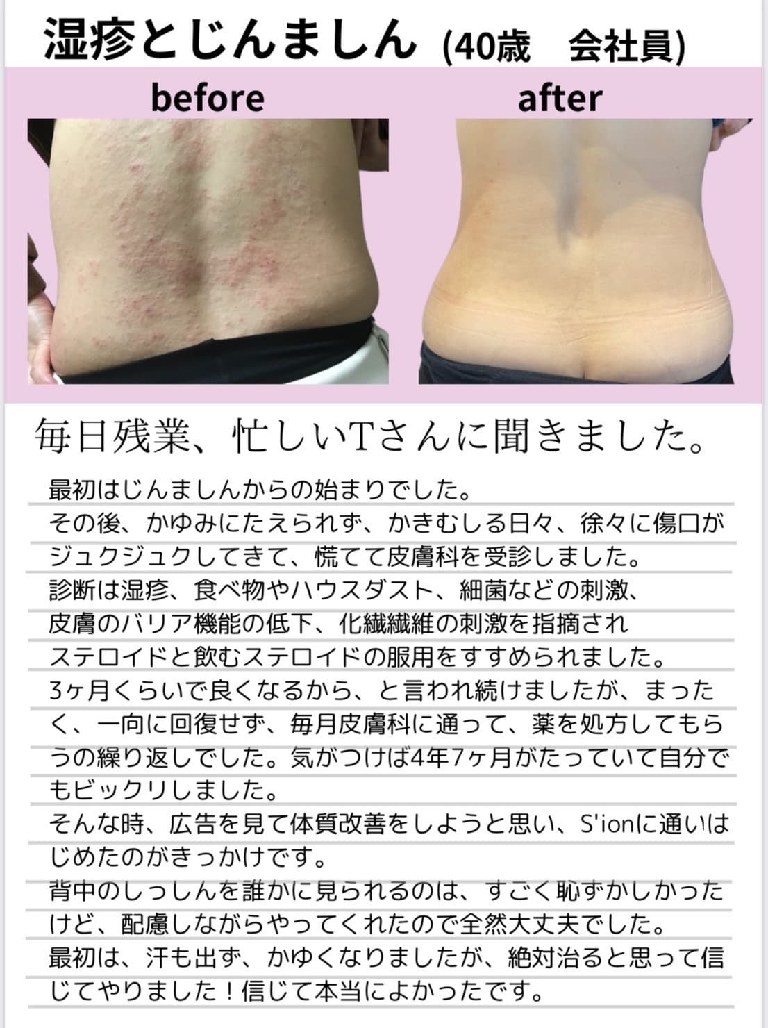 高崎エステ,シオン,口コミ,蕁麻疹改善